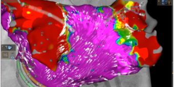 Bild: Linker Vorhof, dargestellt mittels 3D-Mapping Technologie (CARTO ELEVATE)