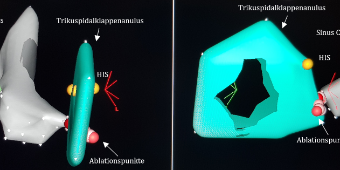 Flyer: 3D-Rekonstruktion bei der Ablation einer AV-Knoten-Reentry-Tachykardie