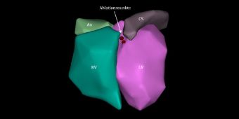 Bild: 3D-Rekonstruktion bei der Ablation einer ventrikulären Extrasystole