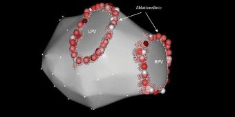 Bild: 3D-Rekonstruktion des linken Vorhofes bei einer Radiofrequenzpulmonalvenenisolation 