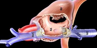 Die implantierte TricValve
