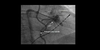 Foto: Radiologisches Bild bei einer Cryo-PVI mittels Kälteballon