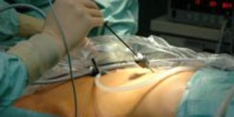 ACH_minimalinvasive Chir.2_72