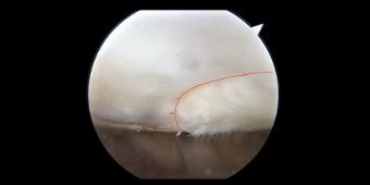 Autocart post Patella 