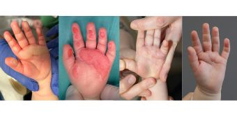 Behandlungsverlauf innerhalb von 9 Monaten Innenfläche Kinderhand thermische Verletzung